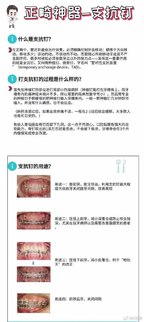 正畸下颌内收支抗如何有效控制？-图3