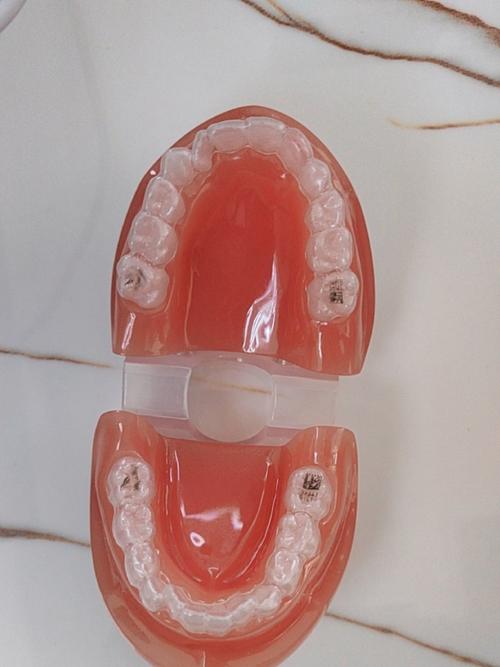 正畸环绕时保持器-图2