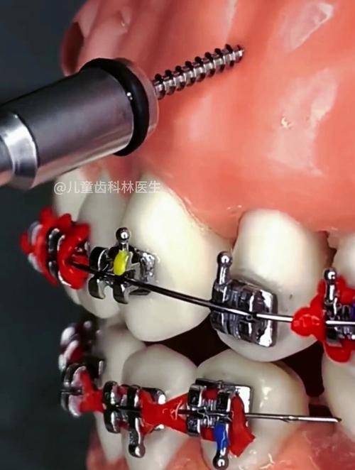 正畸阻抗中心，牙齿移动的力学支点是什么？-图2