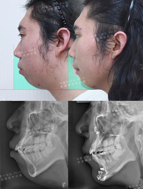 正畸中线同侧偏移-图2