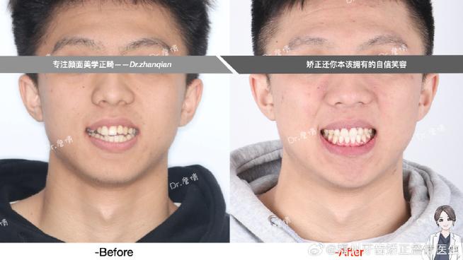 正畸中线同侧偏移-图3