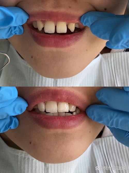 正畸后牙缝变大？原因何在？-图2