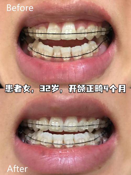 门牙开合想做正畸，矫正效果怎么样？-图1