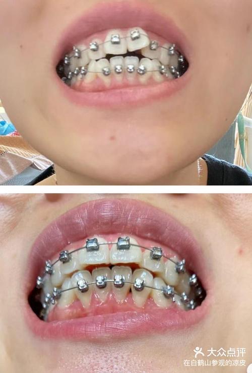 门牙开合想做正畸，矫正效果怎么样？-图2
