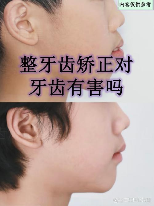 牙齿正畸期间能游泳吗？-图1