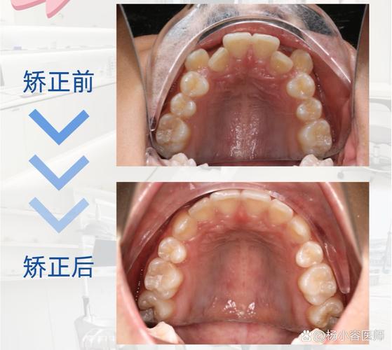 牙齿正畸期间能游泳吗？-图2