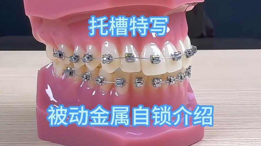 正畸有挂钩的托槽-图2