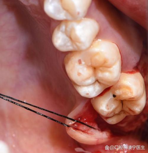 正畸后智齿冒头？原因何在？如何应对？-图1