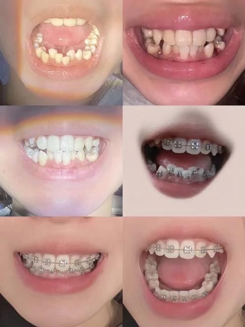 嘉兴二院牙科正畸-图3