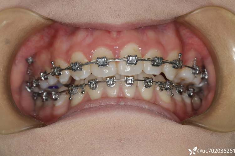 嘉兴二院牙科正畸-图1