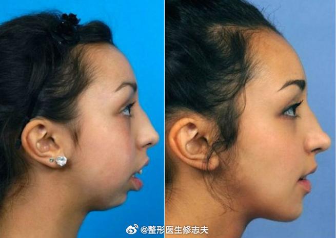 下颌后缩正畸手术效果如何？适合哪些情况？-图3