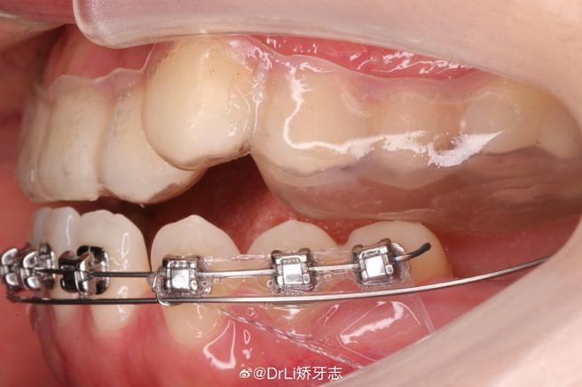 正畸下前牙打转矩-图2
