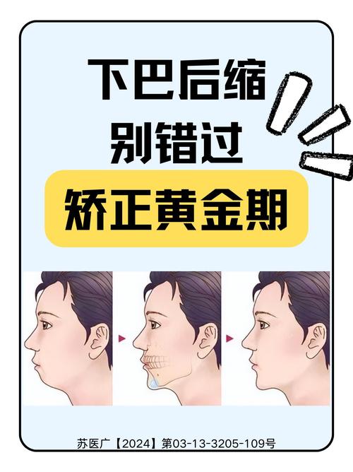 正畸真的会导致下巴后缩吗？-图1