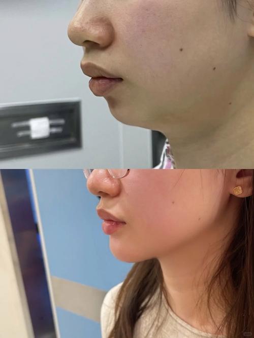 正畸真的会导致下巴后缩吗？-图3