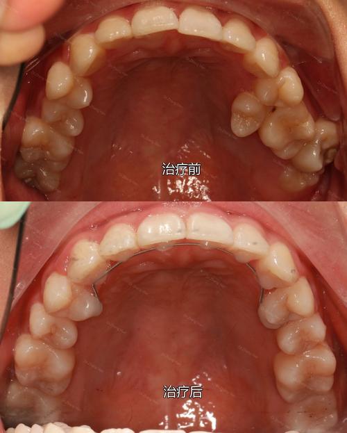 正畸对关节的压力-图3