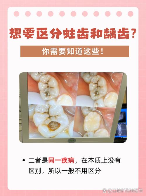 牙齿正畸会让龋齿风险升高吗？-图2