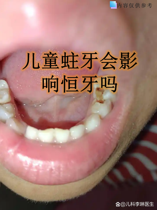 牙齿正畸会让龋齿风险升高吗？-图3