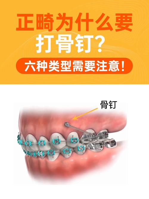 正畸支抗钉各种挂具体指哪些应用技巧？-图2