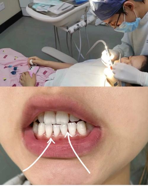 正畸前牙周刮治，为何是矫正成功的关键前提？-图1