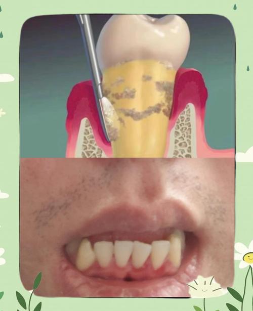 正畸前牙周刮治，为何是矫正成功的关键前提？-图2