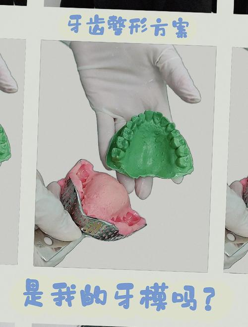 正畸印模制取为何关键？步骤要点与临床应用解析-图1