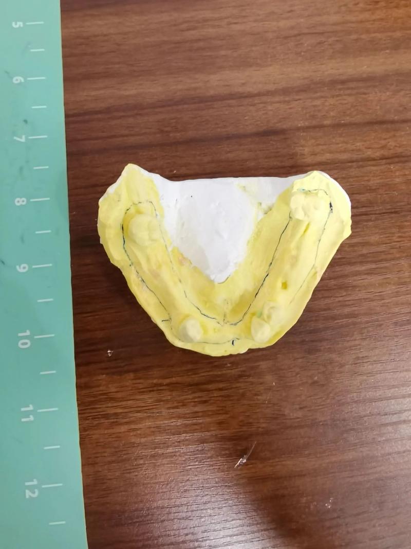 正畸印模制取为何关键？步骤要点与临床应用解析-图2