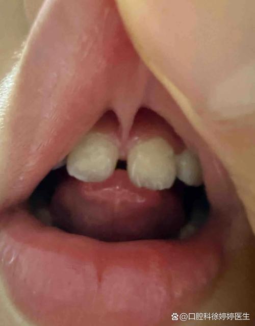 正畸中门牙有缝隙是什么原因导致的？-图2