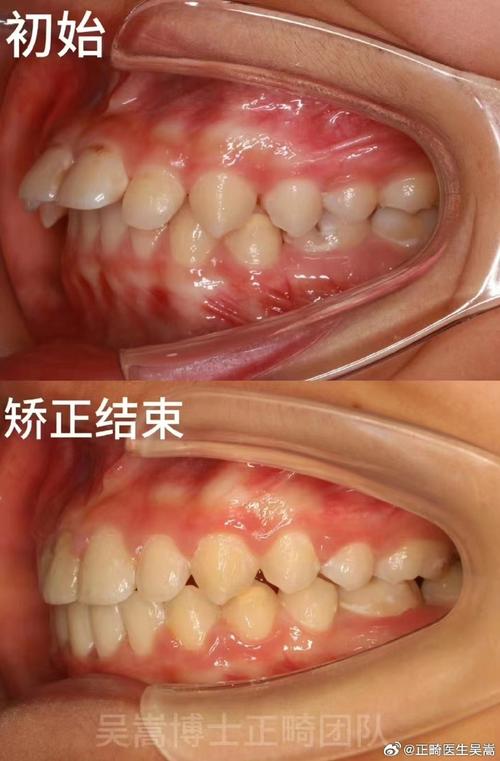 齿性龅牙正畸手术效果如何？-图2