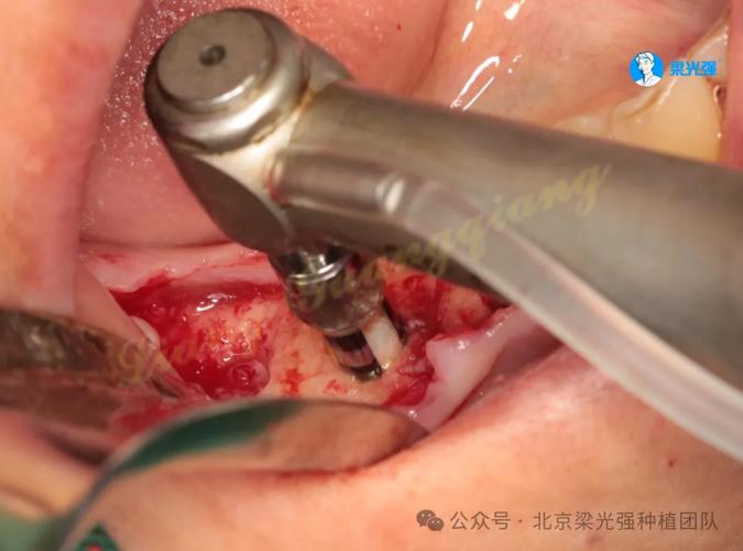 齿性龅牙正畸手术效果如何？-图3