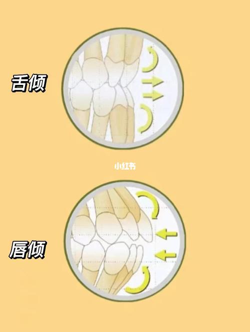 什么时正畸的转矩-图3