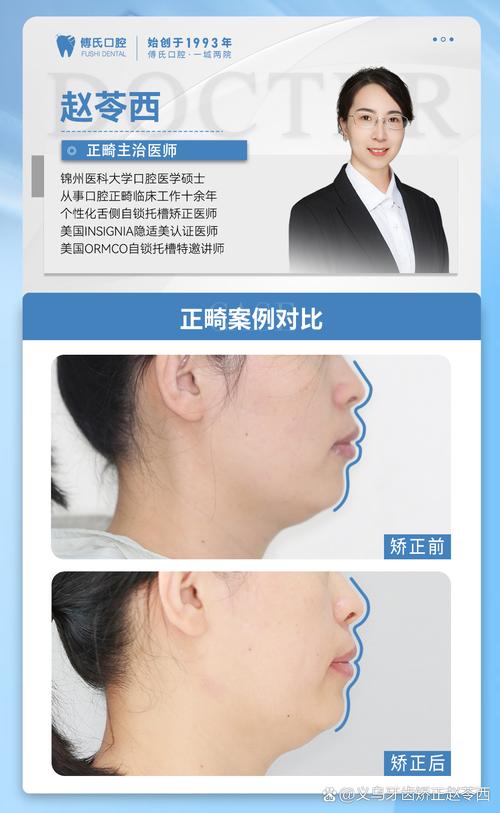 前牙覆合覆盖异常,正畸矫正需关注哪些关键问题?-图1 前牙覆合覆盖异常,正畸矫正需关注哪些关键问题?-图1