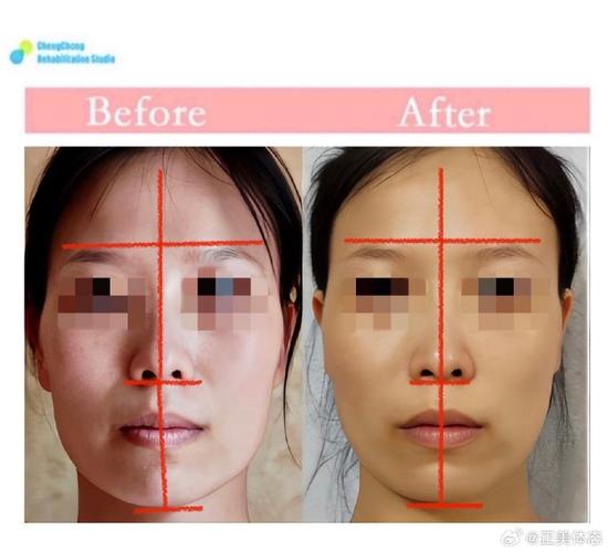 正畸能改变颧骨吗-图1