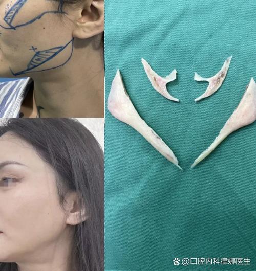 正畸能改变颧骨吗-图2