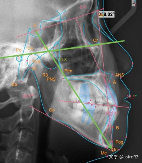 美国正畸头影测量如何精准辅助正畸诊疗？-图1