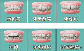 为何越来越多青少年选择牙齿正畸?-图2 为何越来越多青少年选择牙齿正畸?-图2