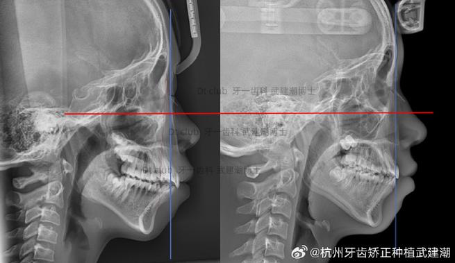 正畸复发 牙槽骨-图2