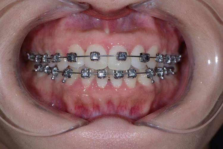 成年正畸能改善偏颌吗？效果及方法有哪些？-图1