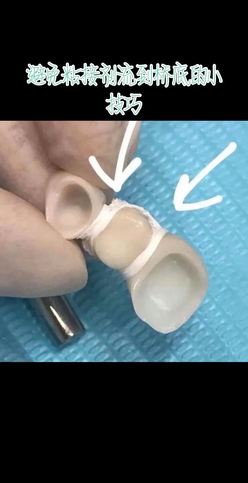 口腔正畸粘接技术-图2