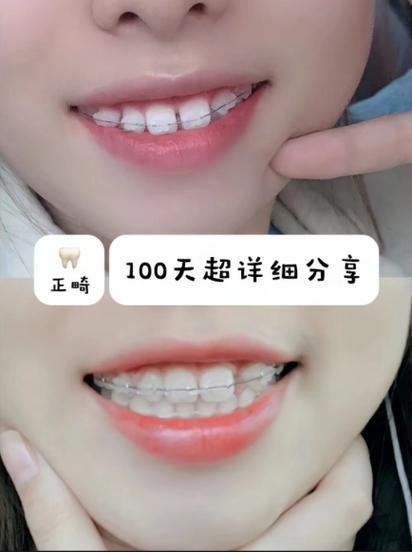 济南口腔正畸哪家好？如何选到靠谱的机构？-图2