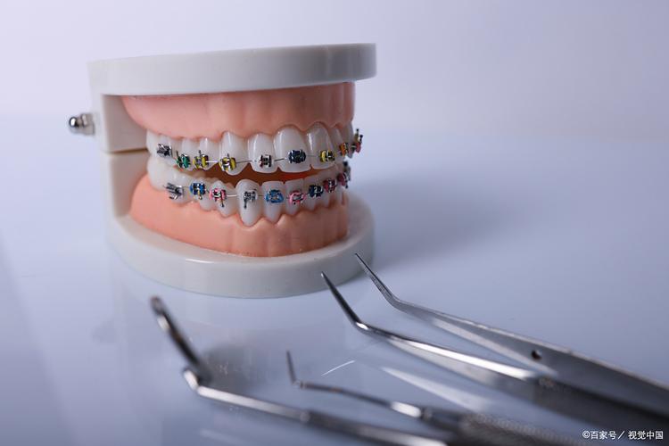 正畸托槽胶老是掉-图2