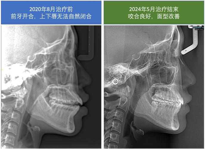 正畸头颅片怎么拍？拍摄步骤、要点与注意事项有哪些？-图1