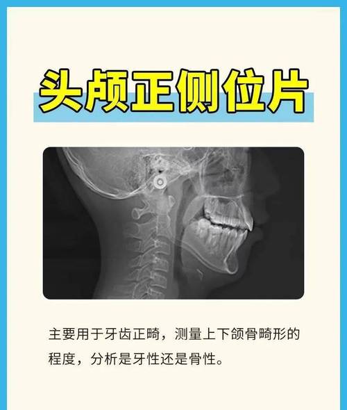 正畸头颅片怎么拍？拍摄步骤、要点与注意事项有哪些？-图2