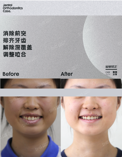 正畸治疗后效果如何？分享牙齿矫正的真实变化与心得？-图2