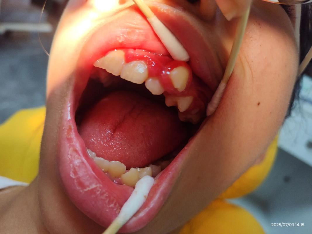 口腔正畸拉错位牙-图1