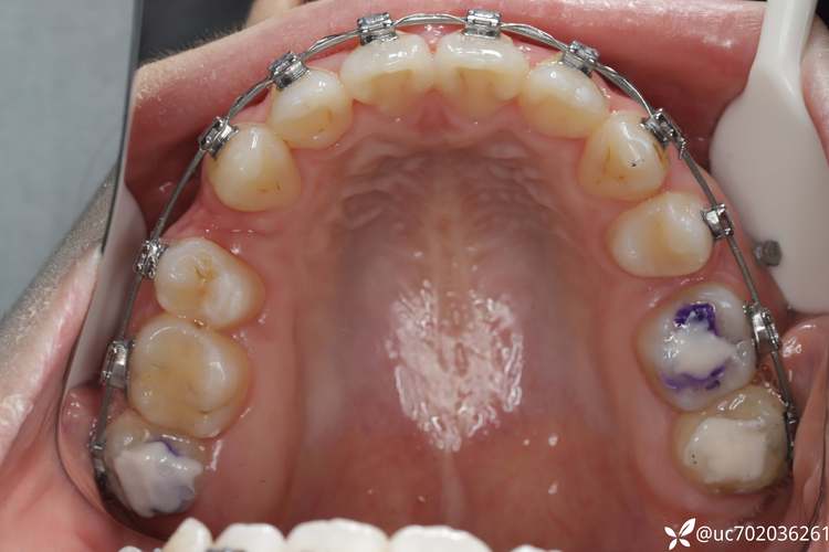 口腔正畸拉错位牙-图2