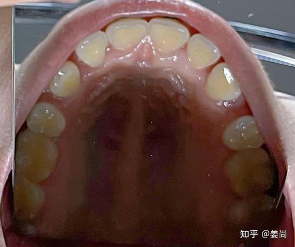 口腔正畸拉错位牙-图3