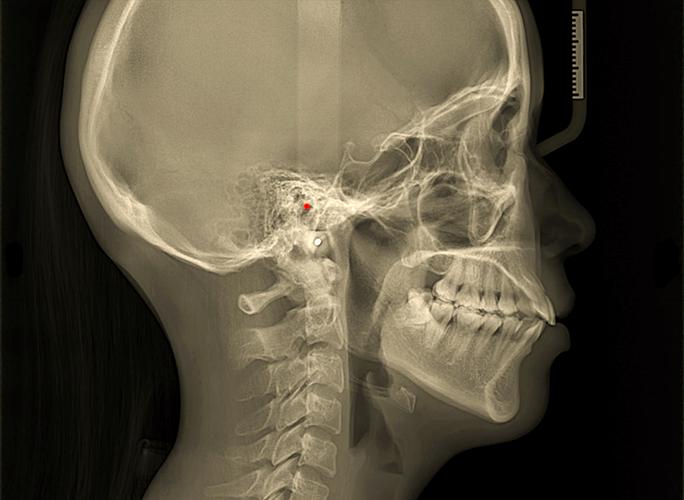 如何理解普特正畸头影测量的应用差异？-图3