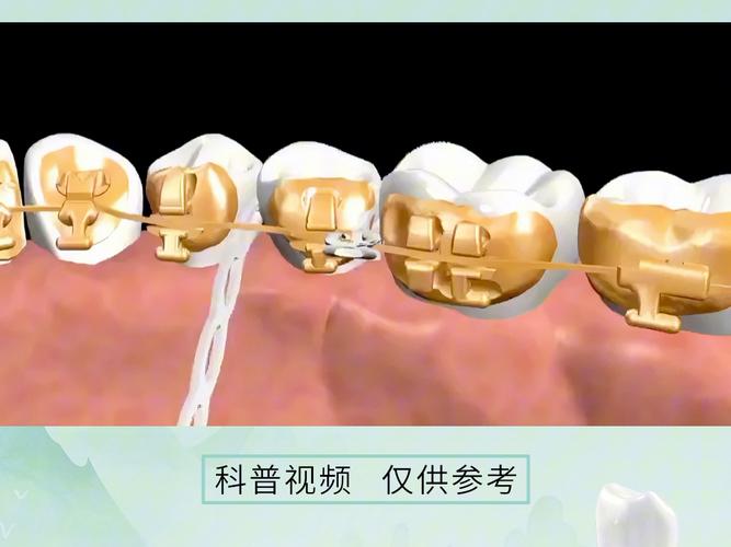 舌侧正畸附件名称-图3