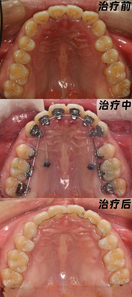 成人开颌隐形正畸可行吗？效果能维持多久？注意事项有哪些？-图2