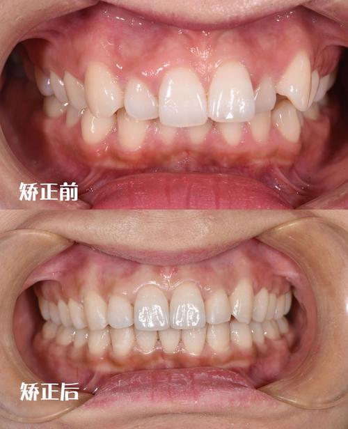 正畸前后X光对比，牙齿骨骼有何变化？-图1